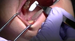 05. Extraction and OsteoGen Plug