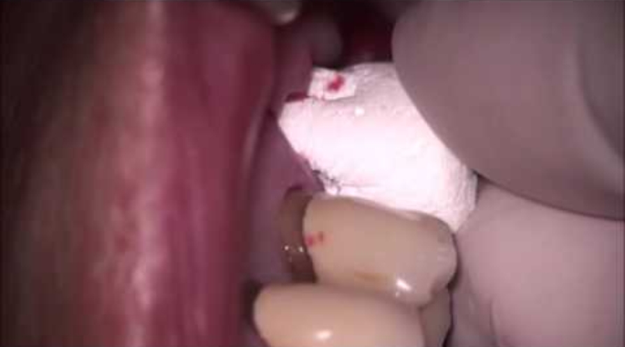 06. OsteoGen Plug Placed into Three Rooted Socket