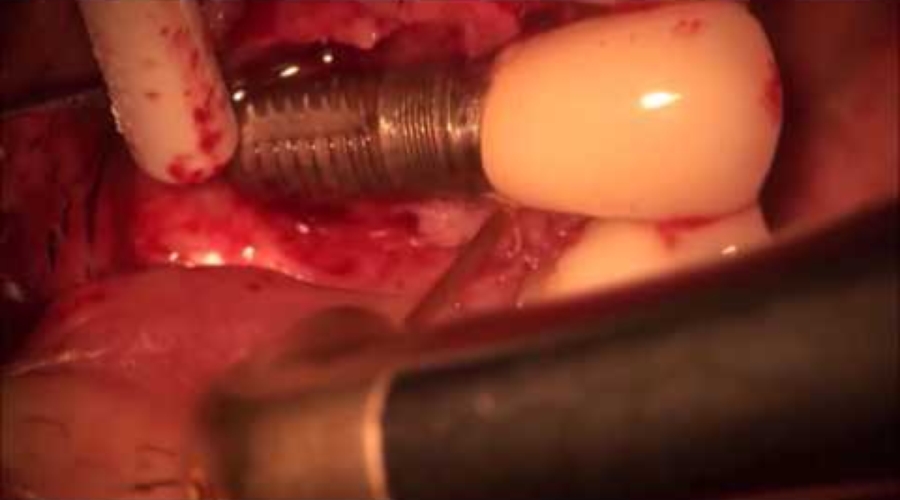 04. Osteogen Plug Peri Implantitis Treatment