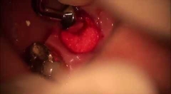 01. Clinical Use of the OsteoGen Plug
