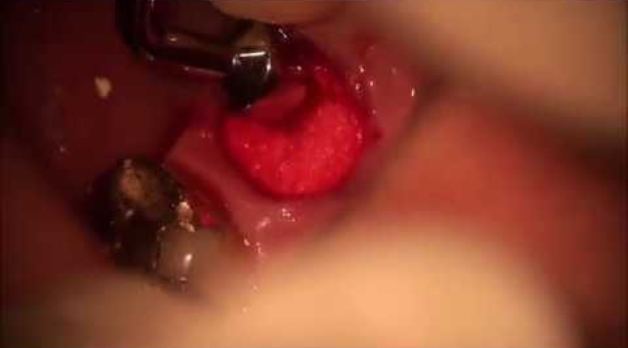 01.Clinical Use of the OsteoGen Plug