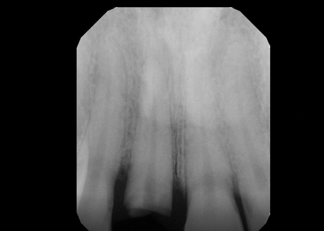 13.Maxillary Central Incisor Extraction Graft & Immediate Implant