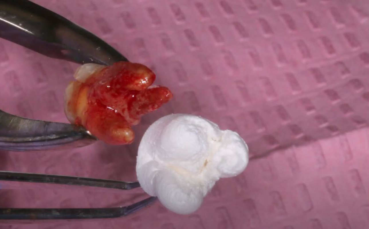 11.Molar extraction and grafting with OsteoGen Plug