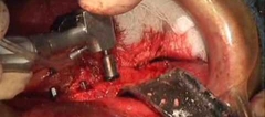 Implant grafting with Osteogen Crystals
