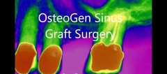 OsteoGen Sinus Graft Surgery