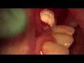 Sinus Perforation Repair