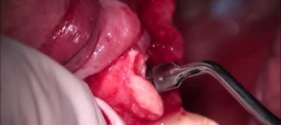 OsteoGen Strip Implant Grafting to Fill Gaps & Reinforce the Buccal Plate